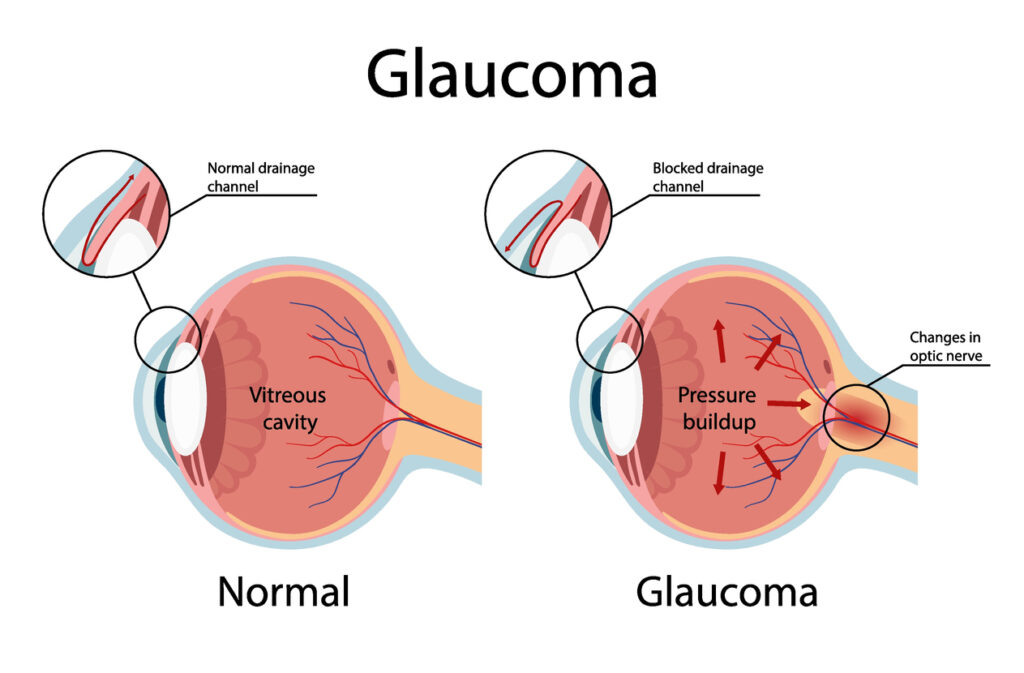 Glaucoma Teartment
