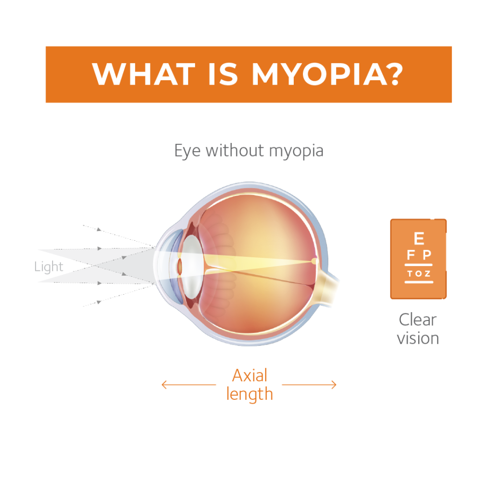 What is Myopia? Progressive Eye Care